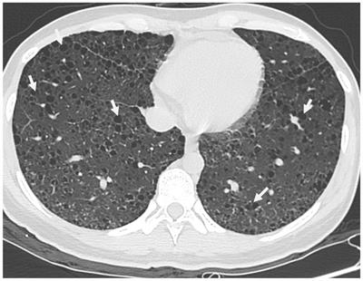 A case report of lymphangioleiomyomatosis with retroperitoneal masses in pregnancy